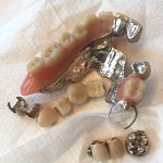 dental bridges made of gold and palladium